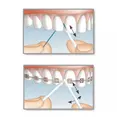 Флос Mirafloss Implant CHX Fine (1,8mm), (Miradent) — Photo 1
